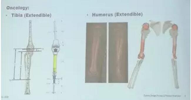 史賽克首席工程師解讀個(gè)性化骨科植入物注冊(cè)