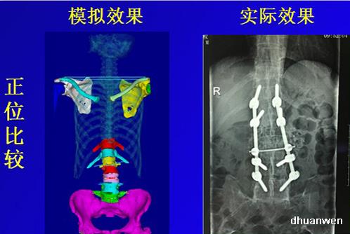 漢邦科技金屬3D打印骨科手術(shù)導(dǎo)板、接骨板及金屬牙冠應(yīng)用案例